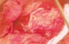 Sural nerve grafting (SNG) - An injury to your cavernous nerve (one or both) may occur at any time during prostate cancer surgery prostate impotence.