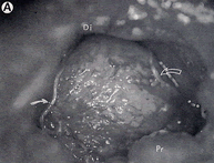 Sural nerve grafting (SNG)